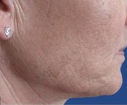Secret RF Before & After Patient #1618